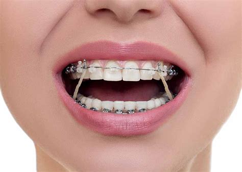 ligas de metal para brackets|brackets con ligas.